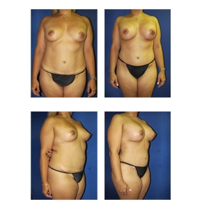 Mommy-Makeover-NYC-Thumbnail-4