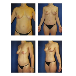 Mommy-Makeover-NYC-thumbnail