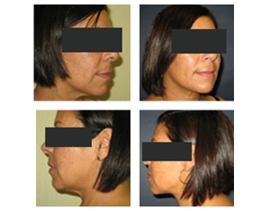 7-non-surgical-necklift