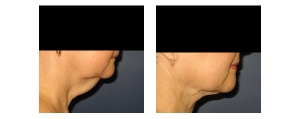 Neck-Lift-Non-Surgical-2