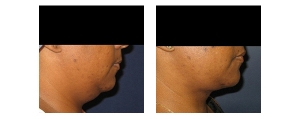 Neck-Lift-Non-Surgical-3