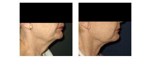 Neck-Lift-Non-Surgical-4