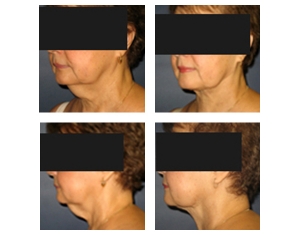 Necklift-Non-Surgical-81