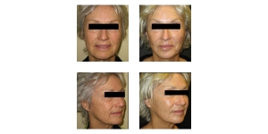 Sculptra-Non-Surgical-Facelift-2