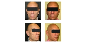 Sculptra-Non-Surgical-Facelift