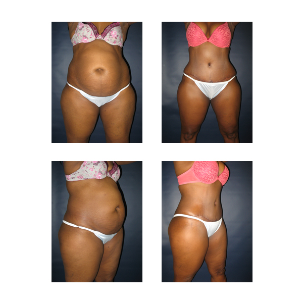 Tummy Tuck Photos  Matthew Schulman, M.D.