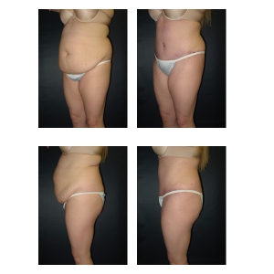 New-York-City-Tummy-Tuck