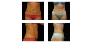 Tummy-Tuck-7