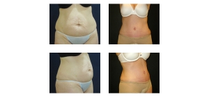Tummy-Tuck-8