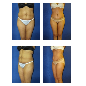 Tummy-Tuck-NYC-Thumbnail1