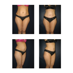 Tummy-Tuck-New-York-City1